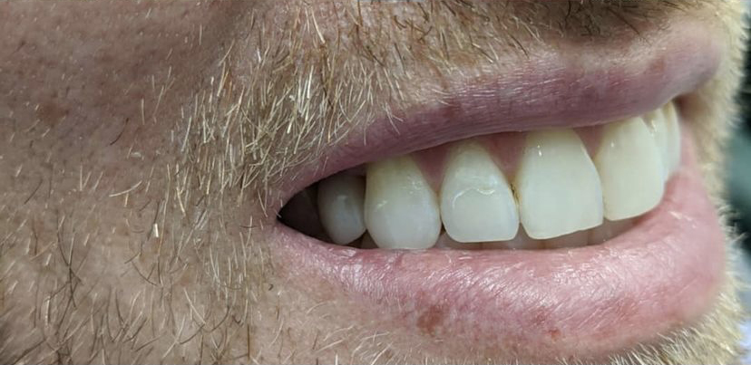 After Professional Teeth Whitening in Leesburg, VA