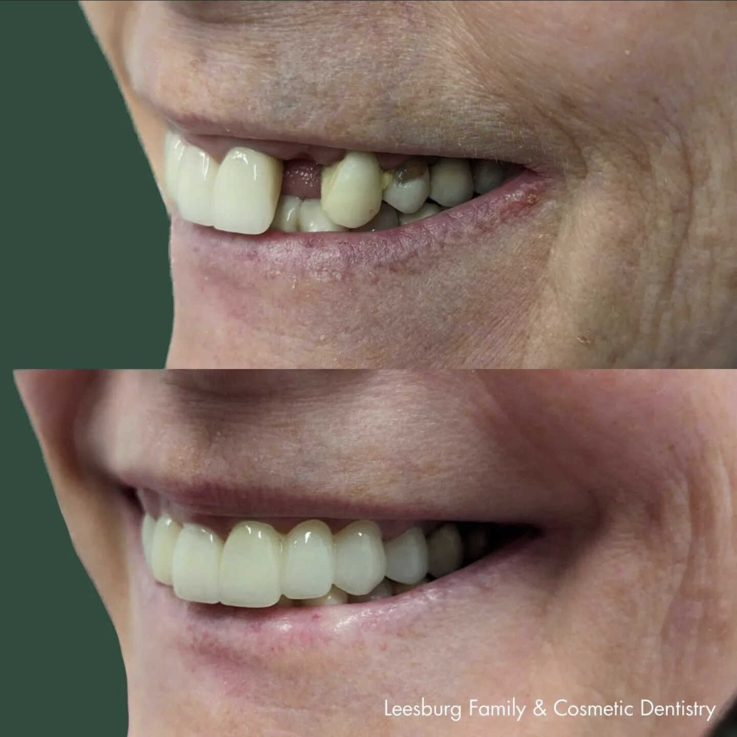 Before & After Dental Bridges in Leesburg, VA