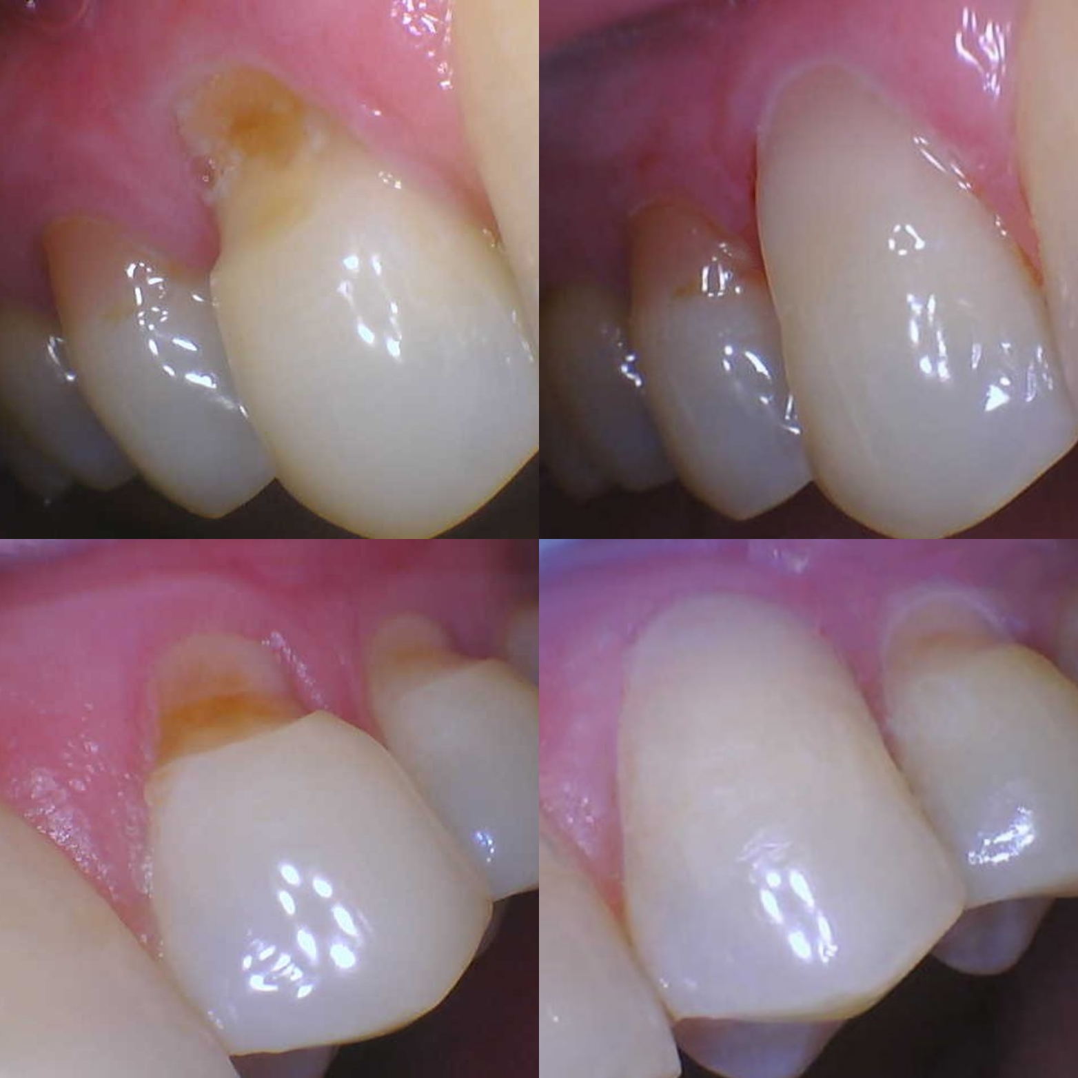 Abfraction Fillings