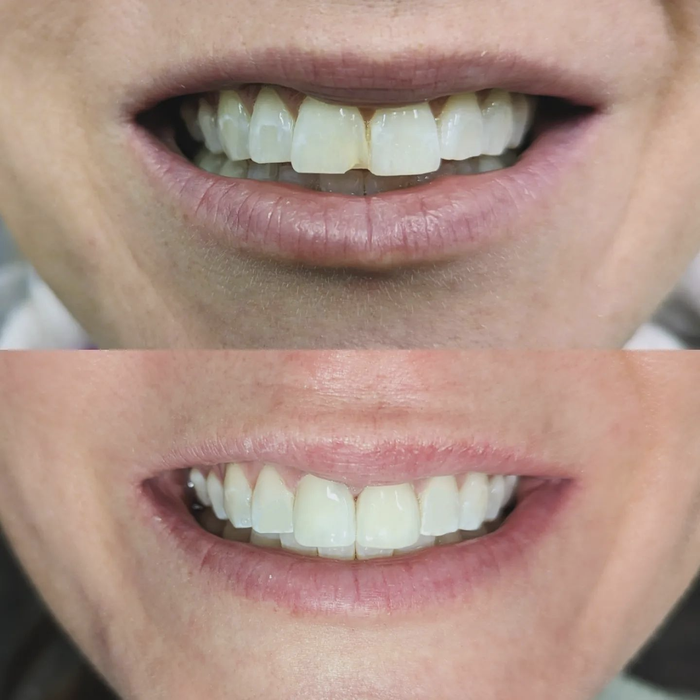 Veneers and Bonding