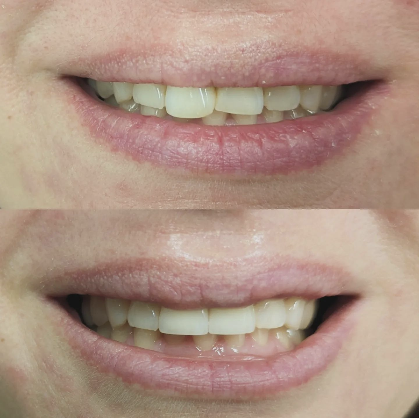 Veneer Treatment