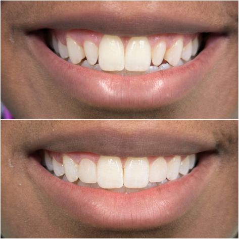 Veneer Treatment